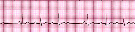 Lethargy in a 65-yr-old Man | Test Interpretation | Case Study 12 | The ...