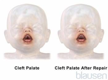 Cleft Palate Repair