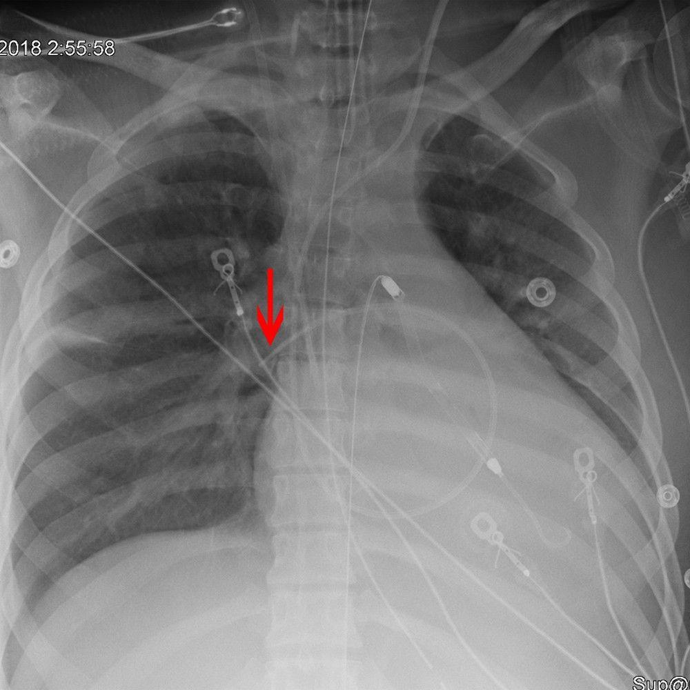 X-Ray Showing Correct Placement of a Swan-Ganz Catheter