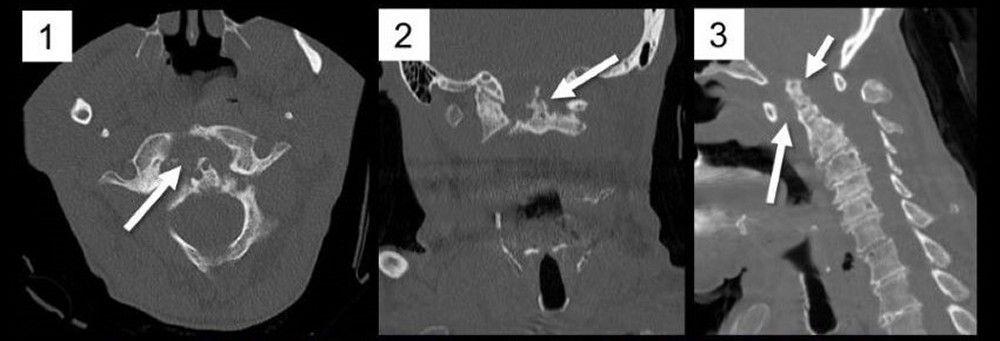 Atlantoaxial Subluxation (CT Scan)