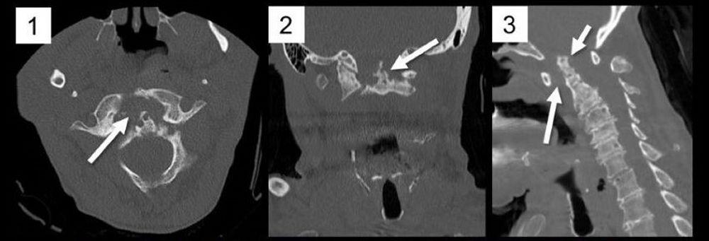 Subluxación atlantoaxial (TC)