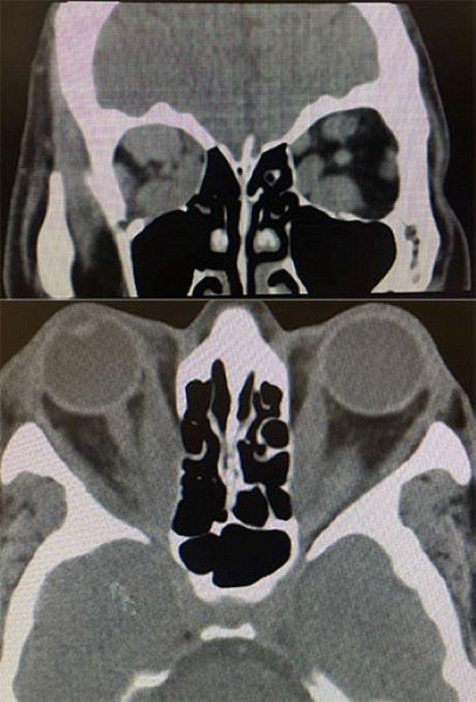 Thyroid Eye Disease (CT Scans)