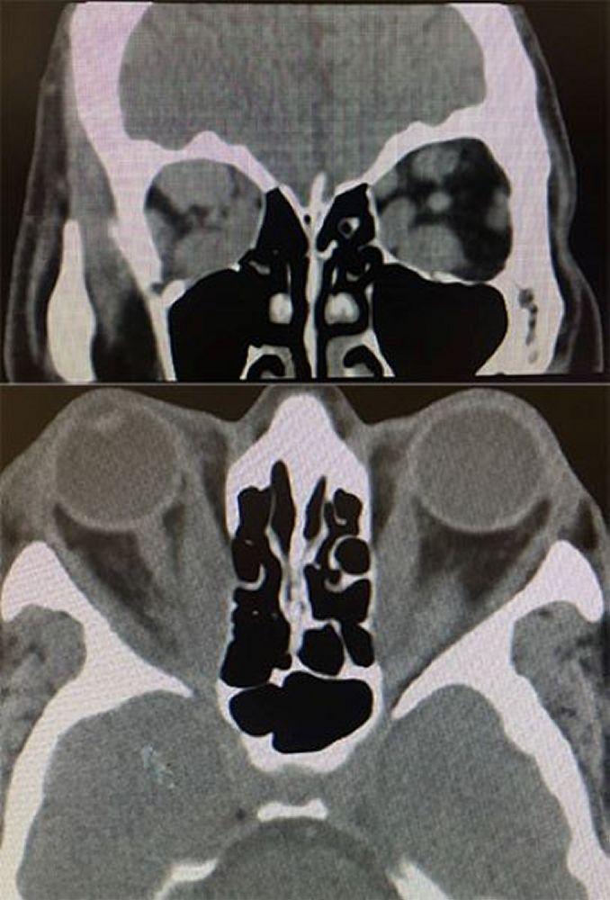 Ophtalmopathie thyroïdienne (TDM)