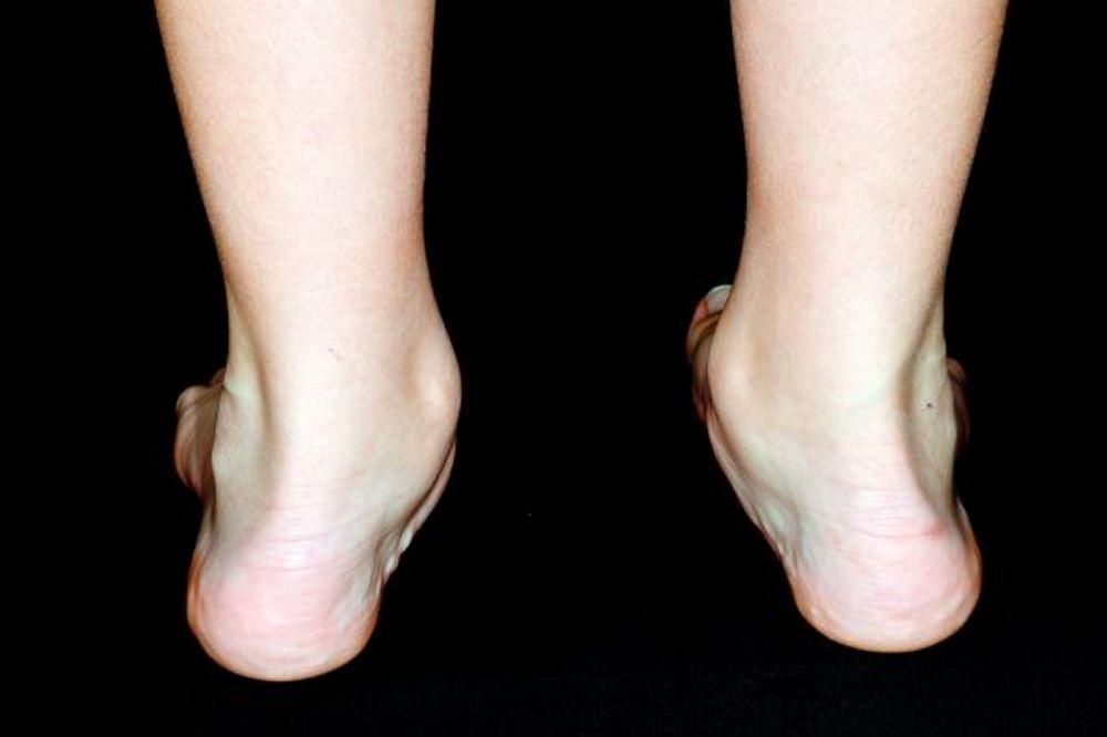 Pes planus (pieds plats)