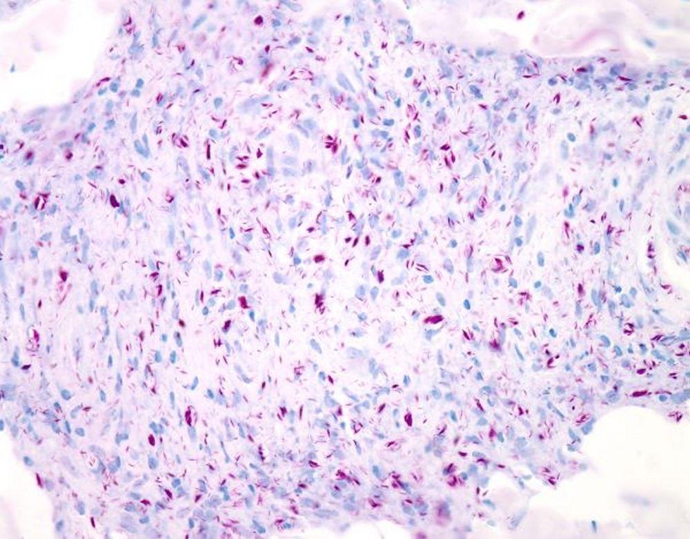 Coloration Ziehl-Neelsen de <i >Mycobacterium leprae</i>