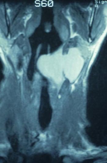 Laryngocèle mixte