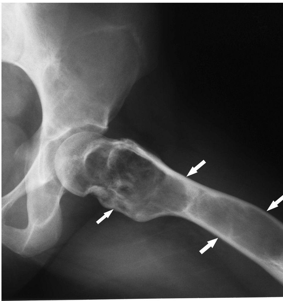 Fibrous Dysplasia