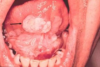 Leucoplasie et carcinome épidermoïde