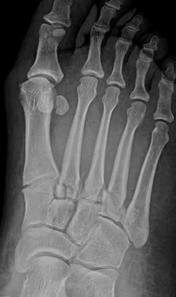 Fracturas de Lisfranc