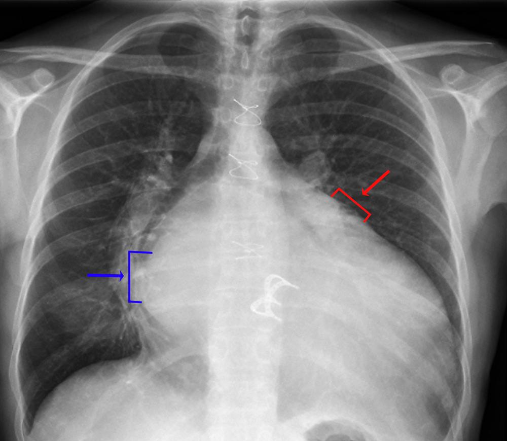 Rx thorax (valvule cardiaque prothétique)