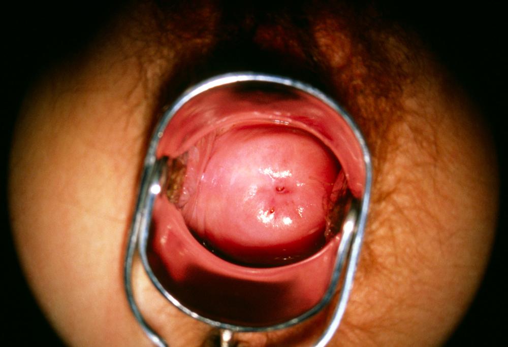 Normal Cervix (Colposcopy)