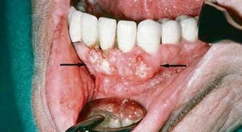 Carcinome malpighien (lésions gingivales)