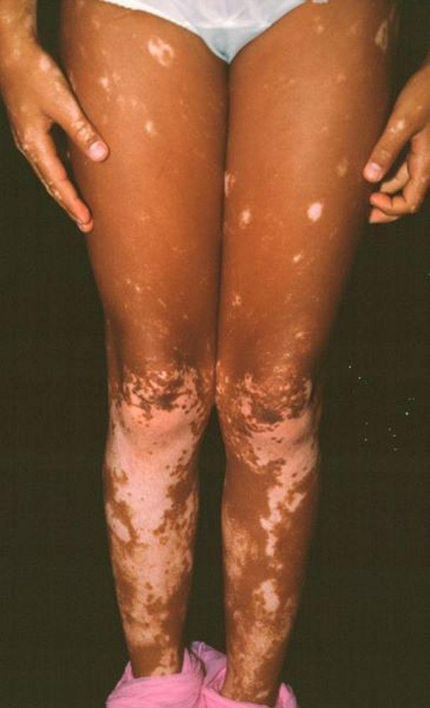 Vitiligo de las piernas inferiores